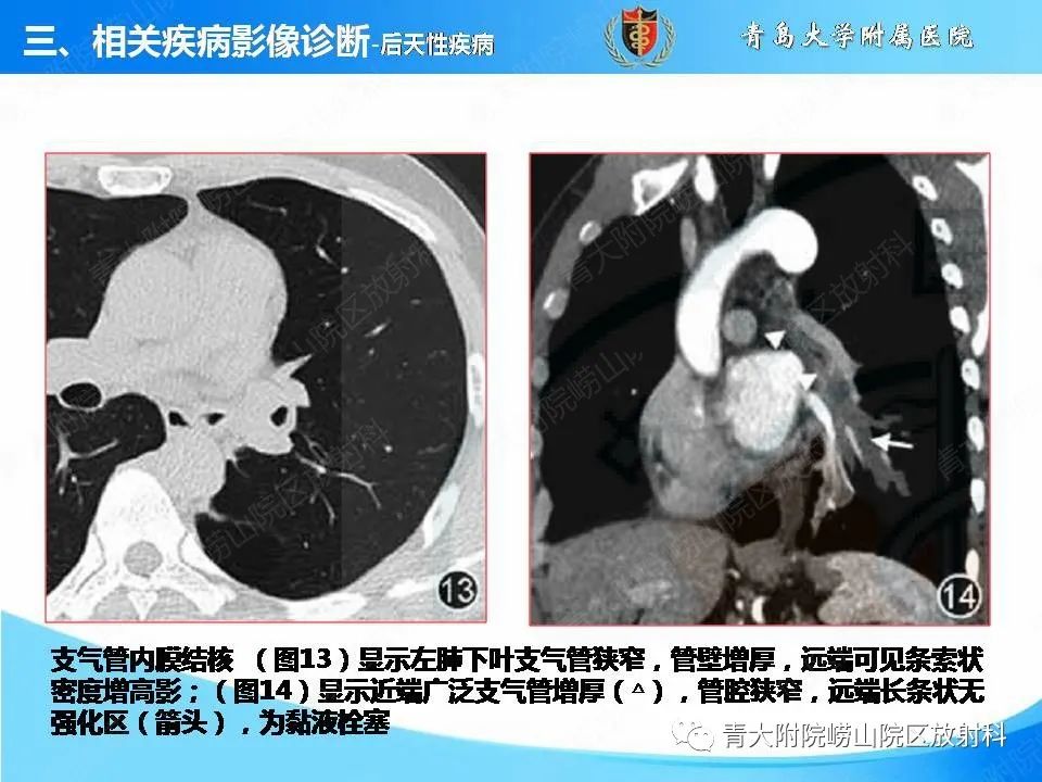 影像PPT - 【PPT】支气管黏液栓塞的影像诊断与鉴别-38