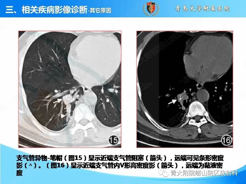 影像PPT - 【PPT】支气管黏液栓塞的影像诊断与鉴别-41