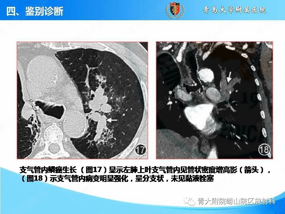 影像PPT - 【PPT】支气管黏液栓塞的影像诊断与鉴别-43