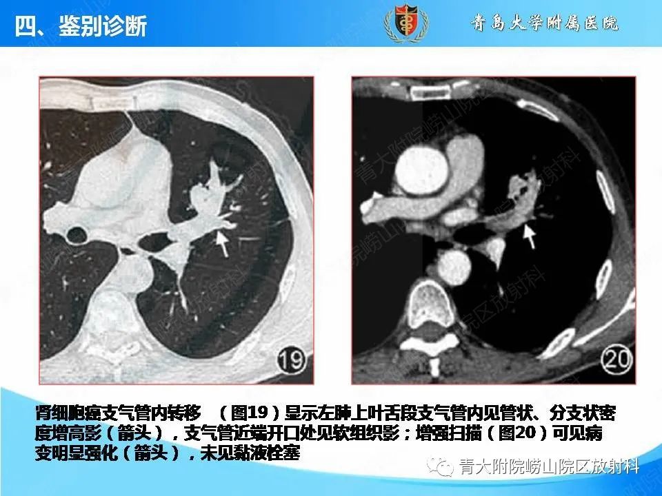 影像PPT - 【PPT】支气管黏液栓塞的影像诊断与鉴别-45