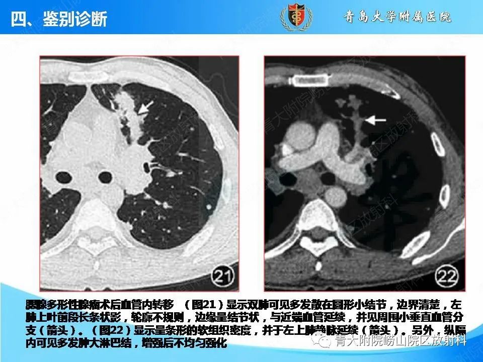 影像PPT - 【PPT】支气管黏液栓塞的影像诊断与鉴别-47