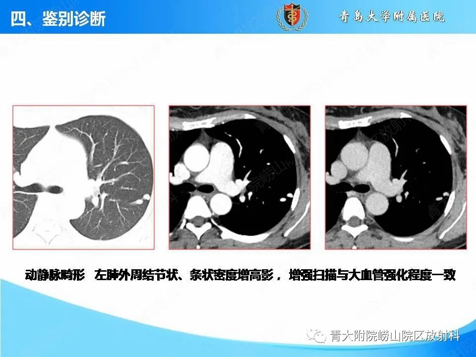 影像PPT - 【PPT】支气管黏液栓塞的影像诊断与鉴别-49