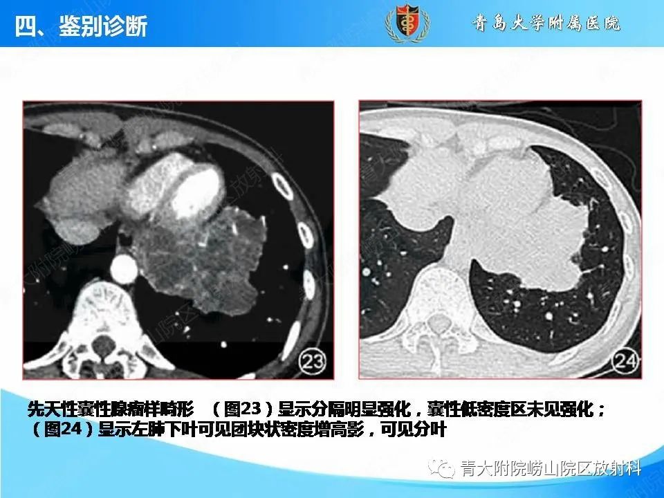 影像PPT - 【PPT】支气管黏液栓塞的影像诊断与鉴别-51