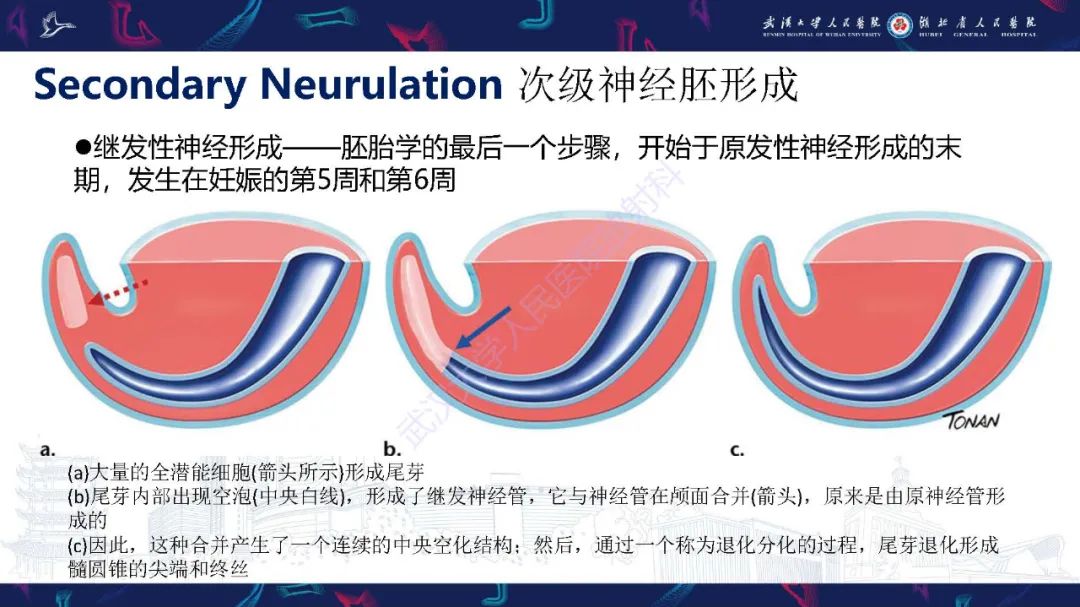 影像PPT - 【PPT】脊柱闭合不全影像诊断-8