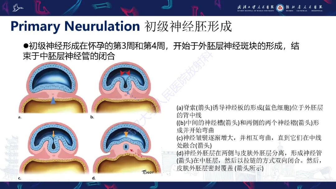 影像PPT - 【PPT】脊柱闭合不全影像诊断-7
