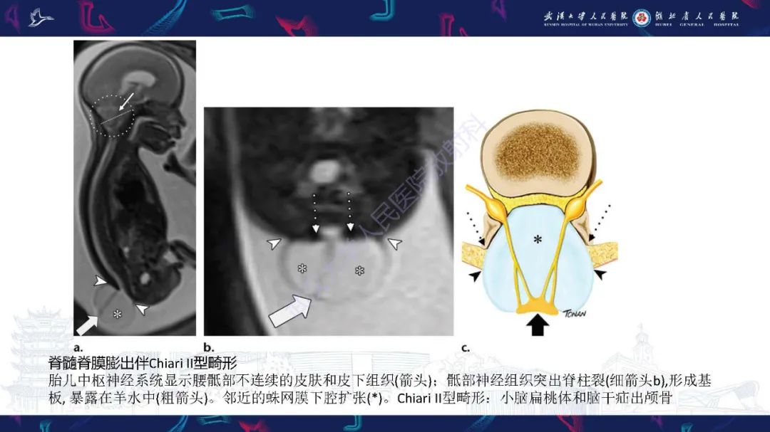 影像PPT - 【PPT】脊柱闭合不全影像诊断-13