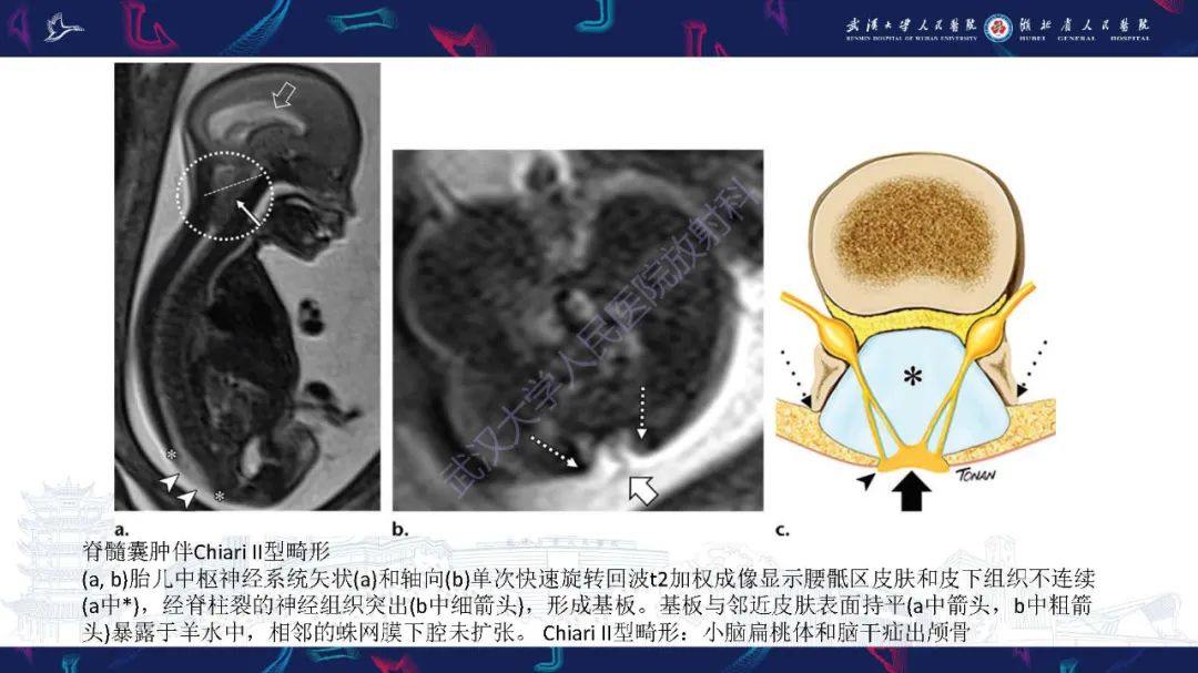 影像PPT - 【PPT】脊柱闭合不全影像诊断-15