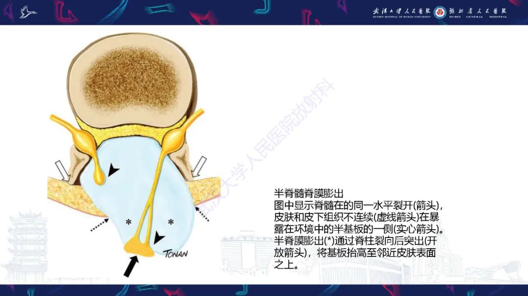 影像PPT - 【PPT】脊柱闭合不全影像诊断-17
