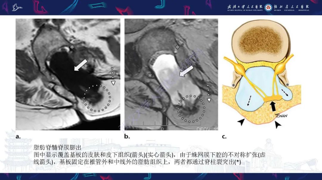影像PPT - 【PPT】脊柱闭合不全影像诊断-20