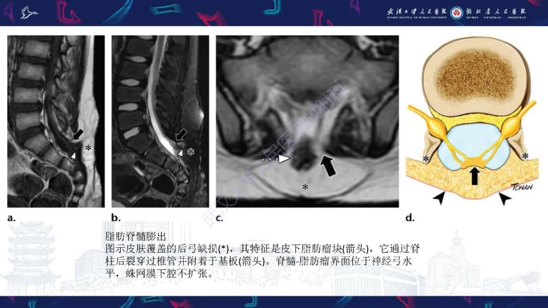 影像PPT - 【PPT】脊柱闭合不全影像诊断-22