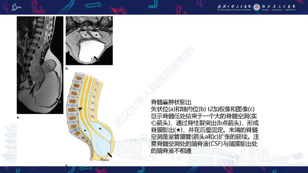 影像PPT - 【PPT】脊柱闭合不全影像诊断-26