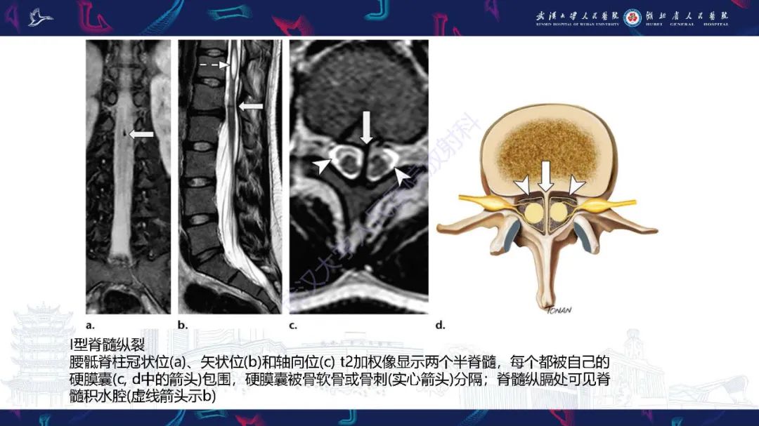 影像PPT - 【PPT】脊柱闭合不全影像诊断-31