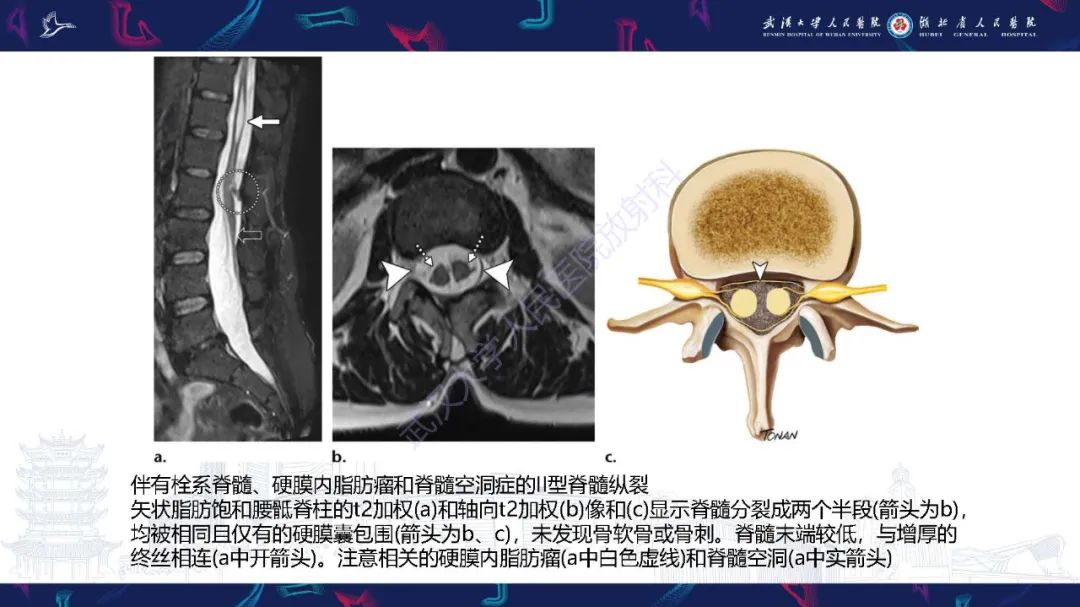 影像PPT - 【PPT】脊柱闭合不全影像诊断-32