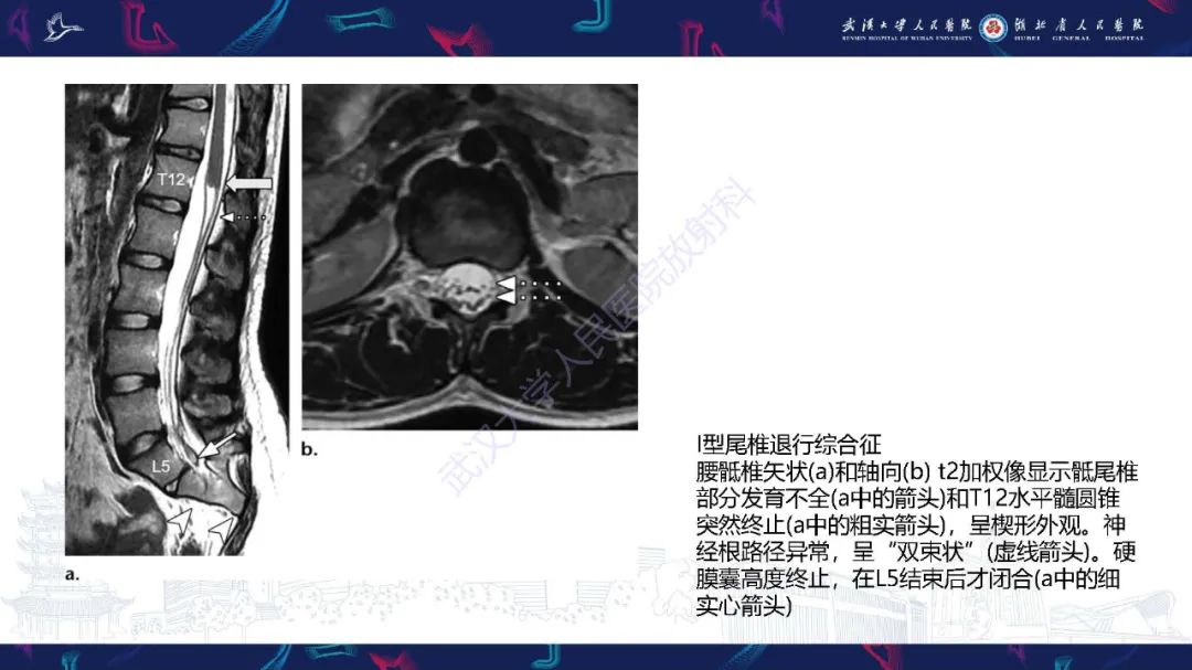 影像PPT - 【PPT】脊柱闭合不全影像诊断-34