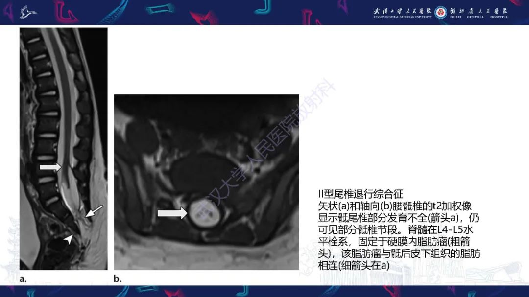 影像PPT - 【PPT】脊柱闭合不全影像诊断-36