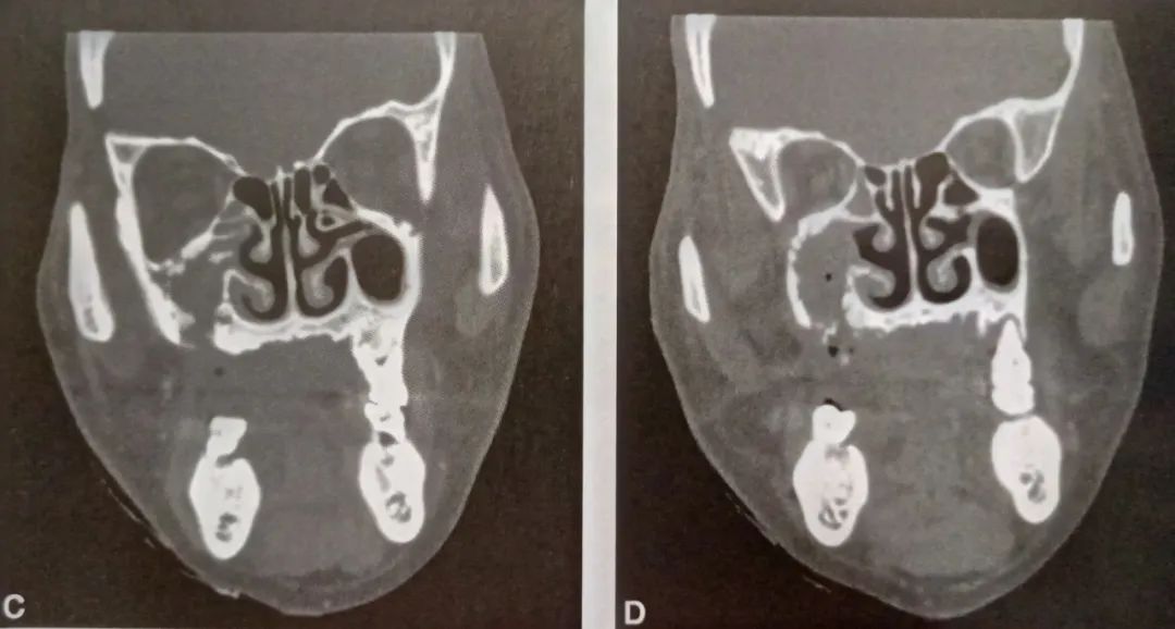影像PPT - 颌骨放射性骨坏死影像诊断-3 影像PPT - 颌骨放射性骨坏死影像诊断-3
