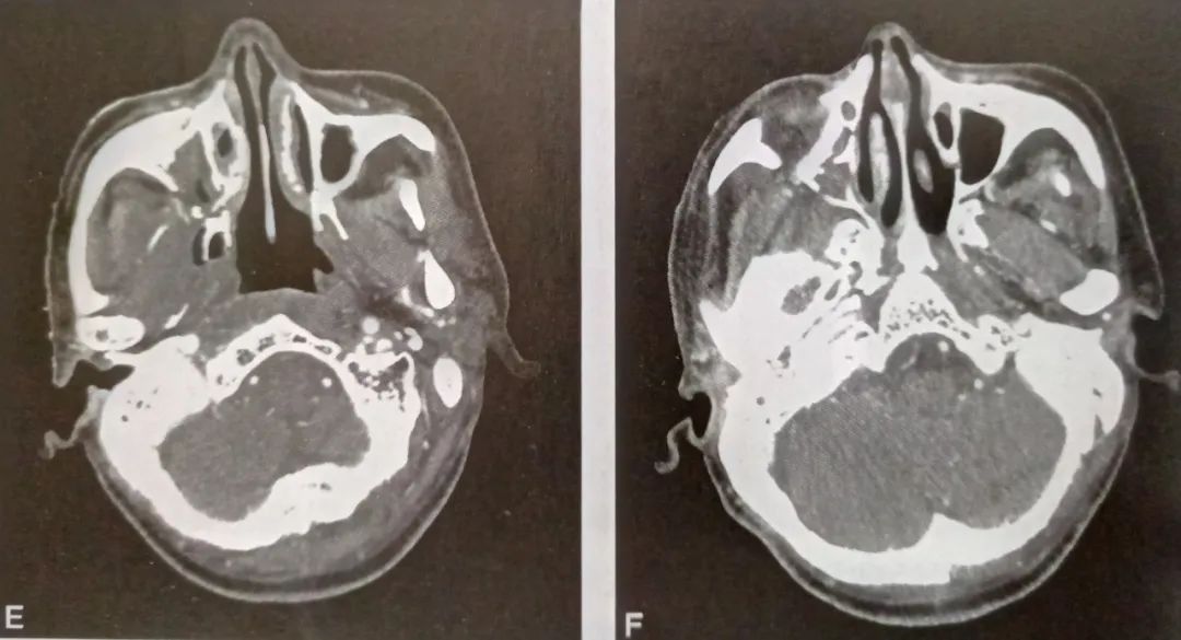 影像PPT - 颌骨放射性骨坏死影像诊断-4 影像PPT - 颌骨放射性骨坏死影像诊断-4