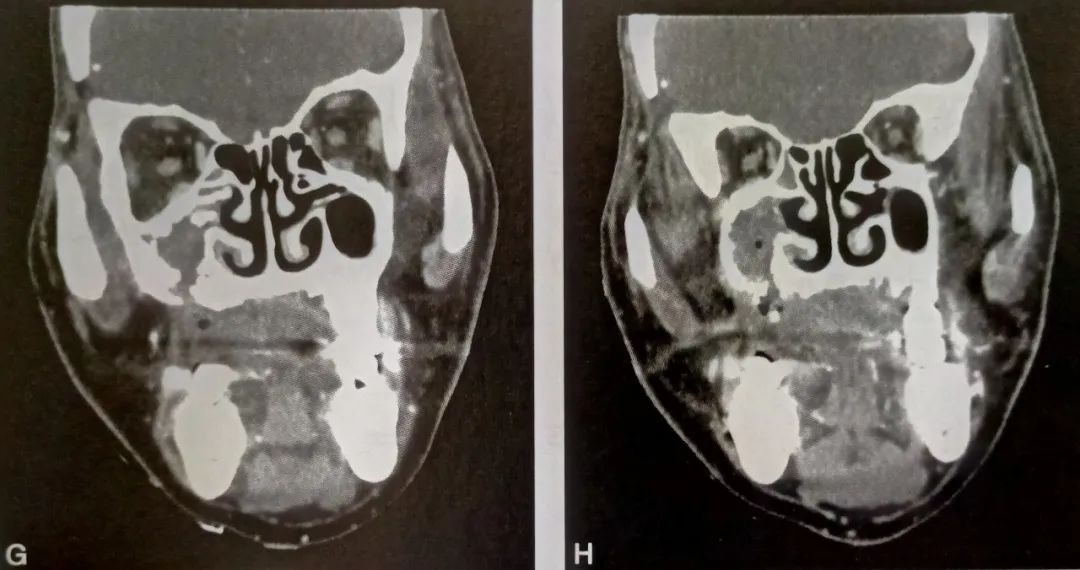 影像PPT - 颌骨放射性骨坏死影像诊断-5 影像PPT - 颌骨放射性骨坏死影像诊断-5