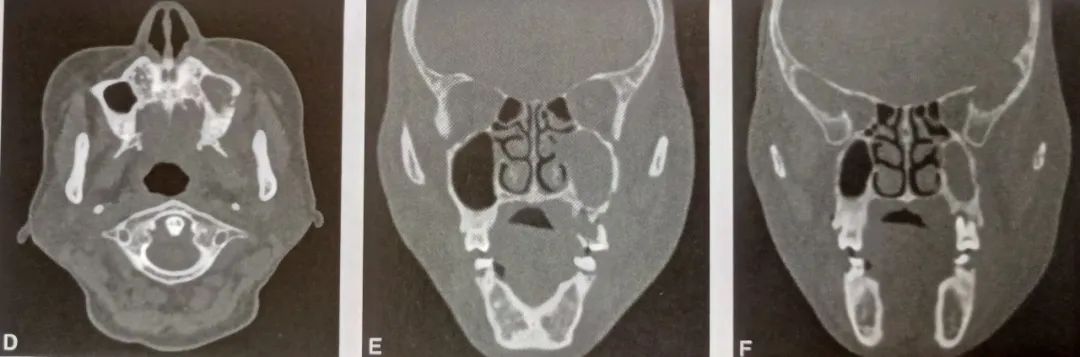 影像PPT - 化学性骨髓炎:双磷酸盐相关性颌骨坏死-3 影像PPT - 化学性骨髓炎:双磷酸盐相关性颌骨坏死-3