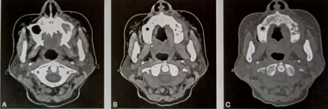 影像PPT - 化学性骨髓炎:双磷酸盐相关性颌骨坏死-2 影像PPT - 化学性骨髓炎:双磷酸盐相关性颌骨坏死-2