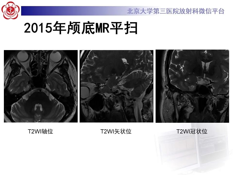 影像PPT - 【PPT】颅内三叉神经鞘瘤-3