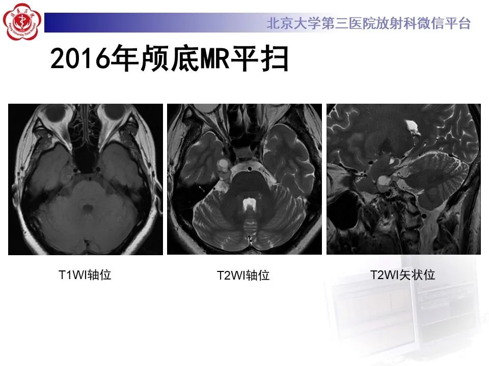 影像PPT - 【PPT】颅内三叉神经鞘瘤-4