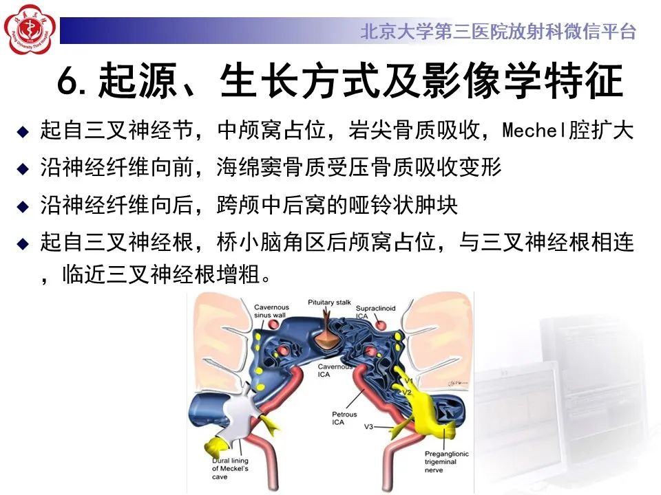 影像PPT - 【PPT】颅内三叉神经鞘瘤-14
