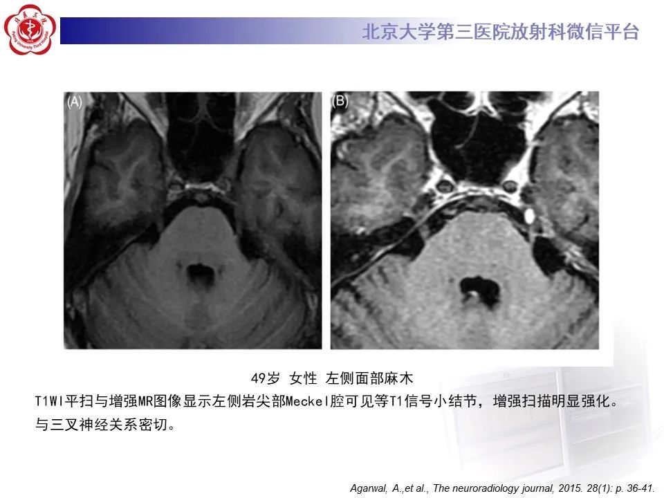 影像PPT - 【PPT】颅内三叉神经鞘瘤-17