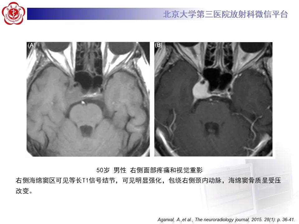 影像PPT - 【PPT】颅内三叉神经鞘瘤-18