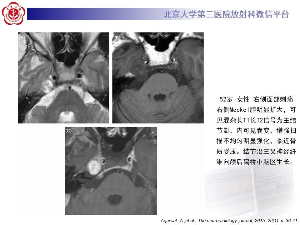 影像PPT - 【PPT】颅内三叉神经鞘瘤-19