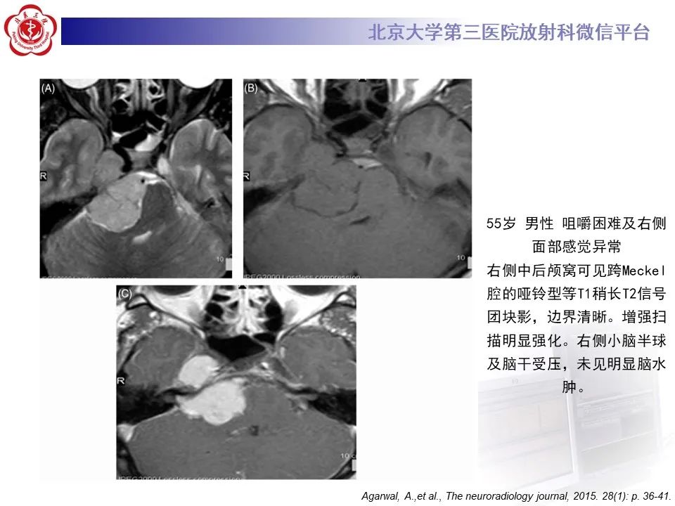 影像PPT - 【PPT】颅内三叉神经鞘瘤-20