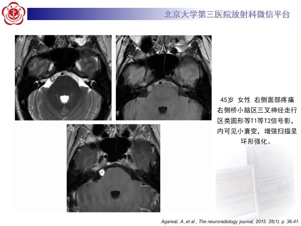 影像PPT - 【PPT】颅内三叉神经鞘瘤-21