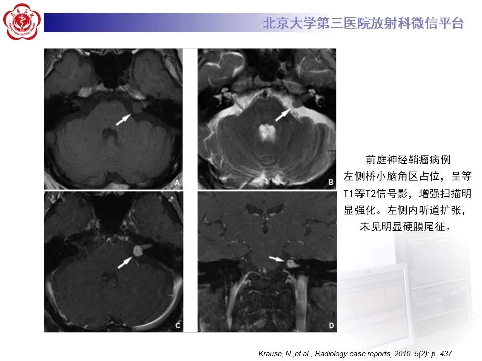 影像PPT - 【PPT】颅内三叉神经鞘瘤-31