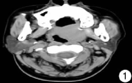 影像PPT - 【病例】易误诊病例 —扁桃体淋巴组织反应性增生1例CT-7 影像PPT - 【病例】易误诊病例 —扁桃体淋巴组织反应性增生1例CT-7