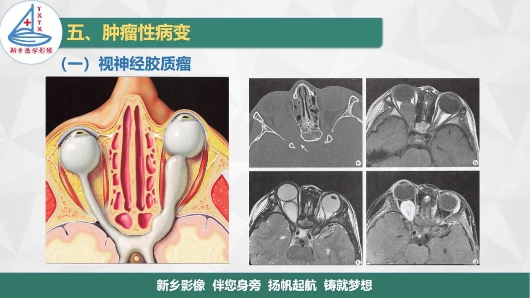 影像PPT - 【PPT】医学影像诊断学教材解读—眼部疾病-5