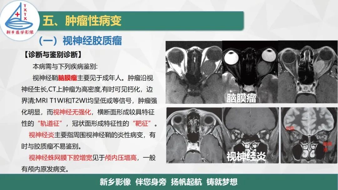 影像PPT - 【PPT】医学影像诊断学教材解读—眼部疾病-6
