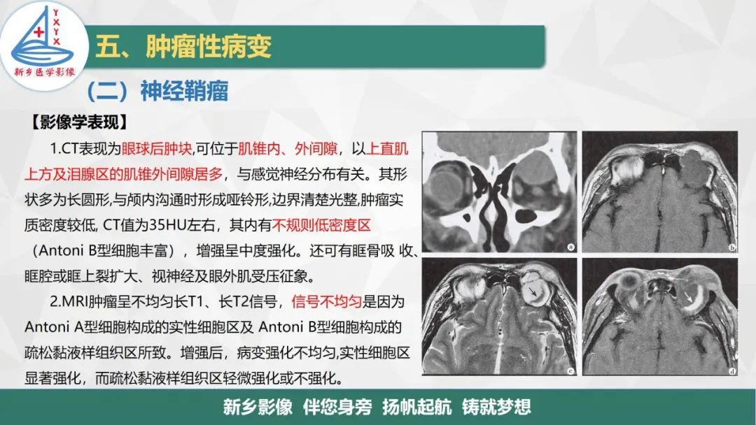 影像PPT - 【PPT】医学影像诊断学教材解读—眼部疾病-8