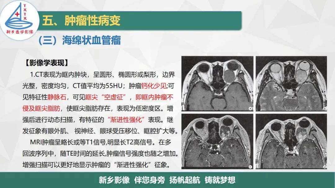 影像PPT - 【PPT】医学影像诊断学教材解读—眼部疾病-11