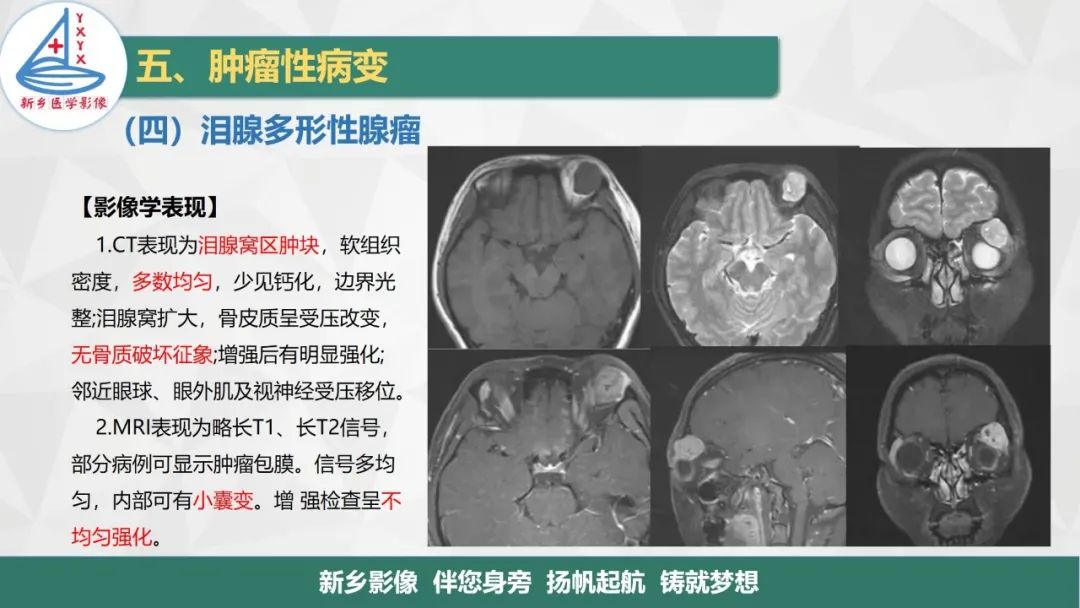 影像PPT - 【PPT】医学影像诊断学教材解读—眼部疾病-13
