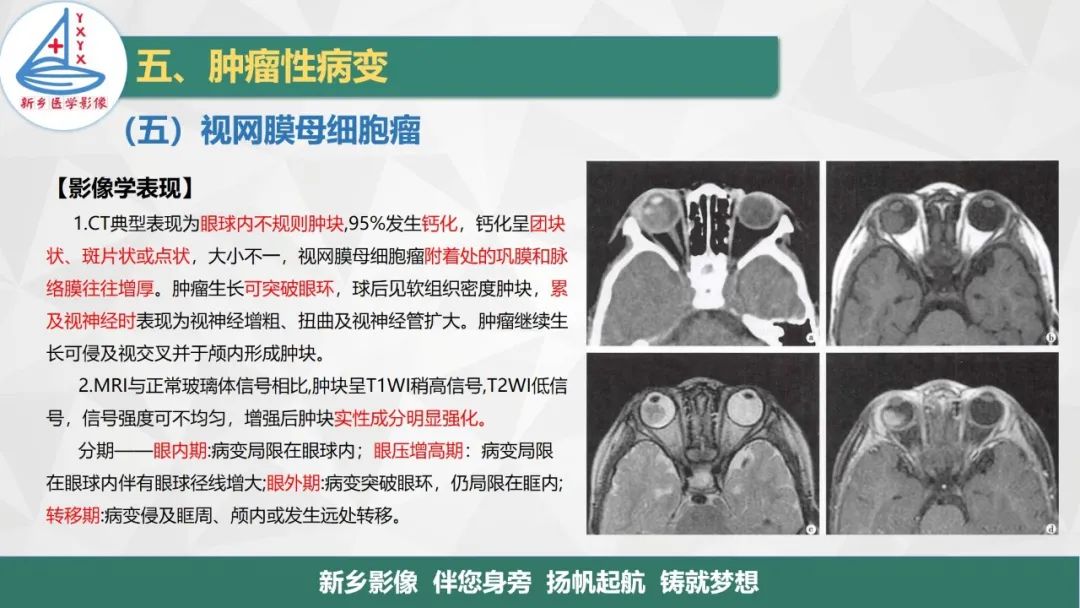 影像PPT - 【PPT】医学影像诊断学教材解读—眼部疾病-15