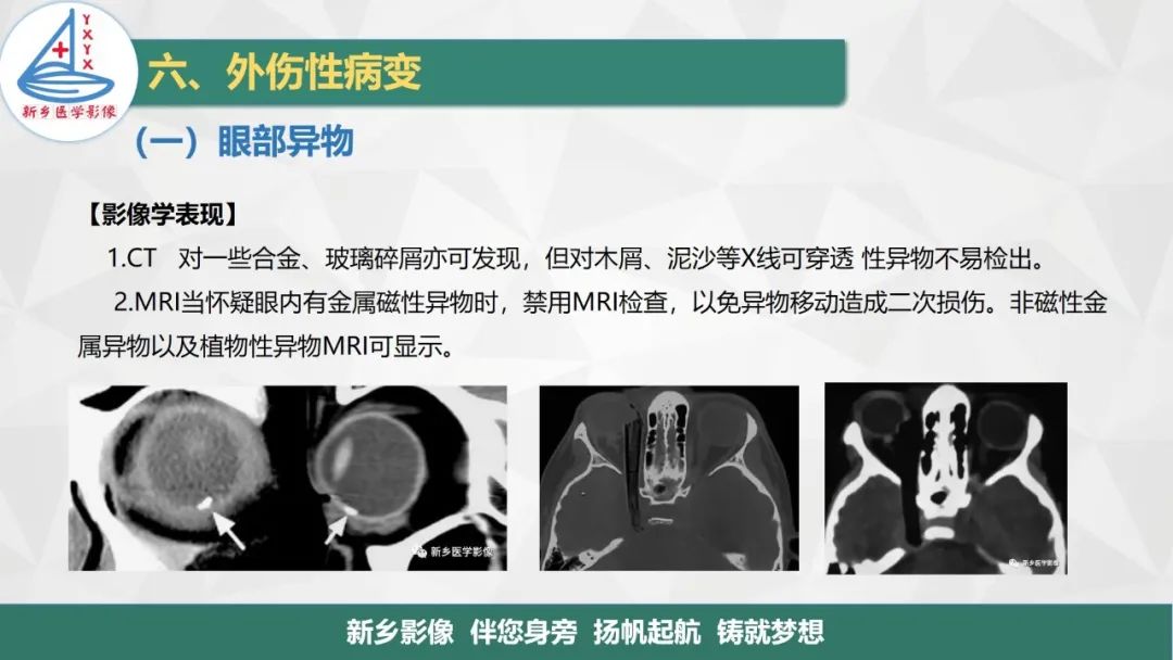 影像PPT - 【PPT】医学影像诊断学教材解读—眼部疾病-18