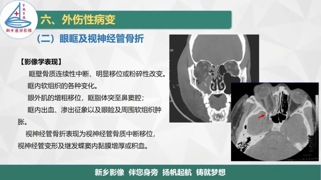 影像PPT - 【PPT】医学影像诊断学教材解读—眼部疾病-20