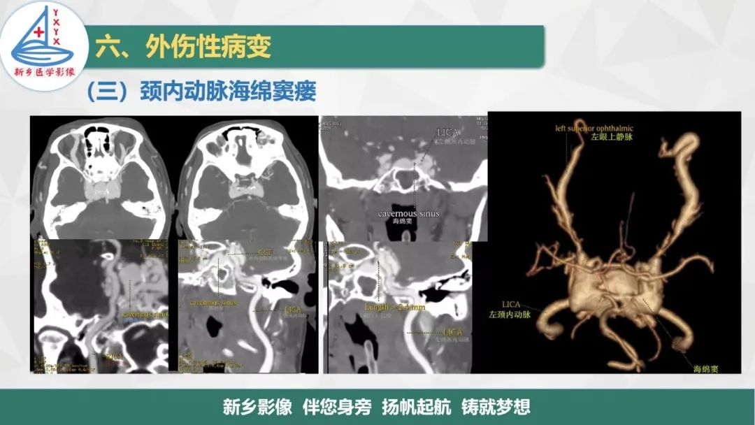 影像PPT - 【PPT】医学影像诊断学教材解读—眼部疾病-22