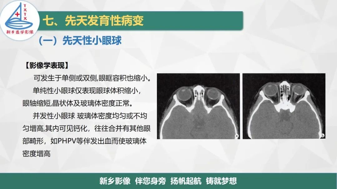 影像PPT - 【PPT】医学影像诊断学教材解读—眼部疾病-25