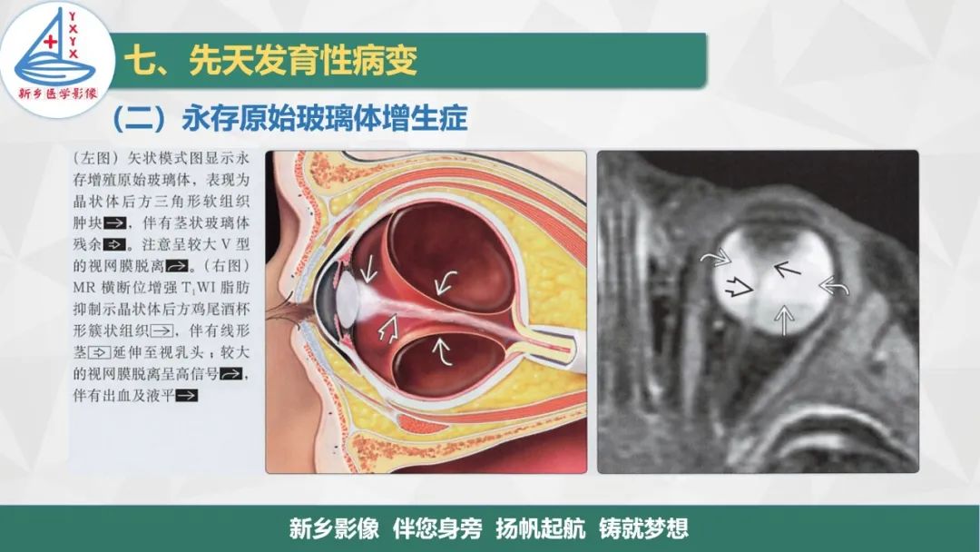 影像PPT - 【PPT】医学影像诊断学教材解读—眼部疾病-27