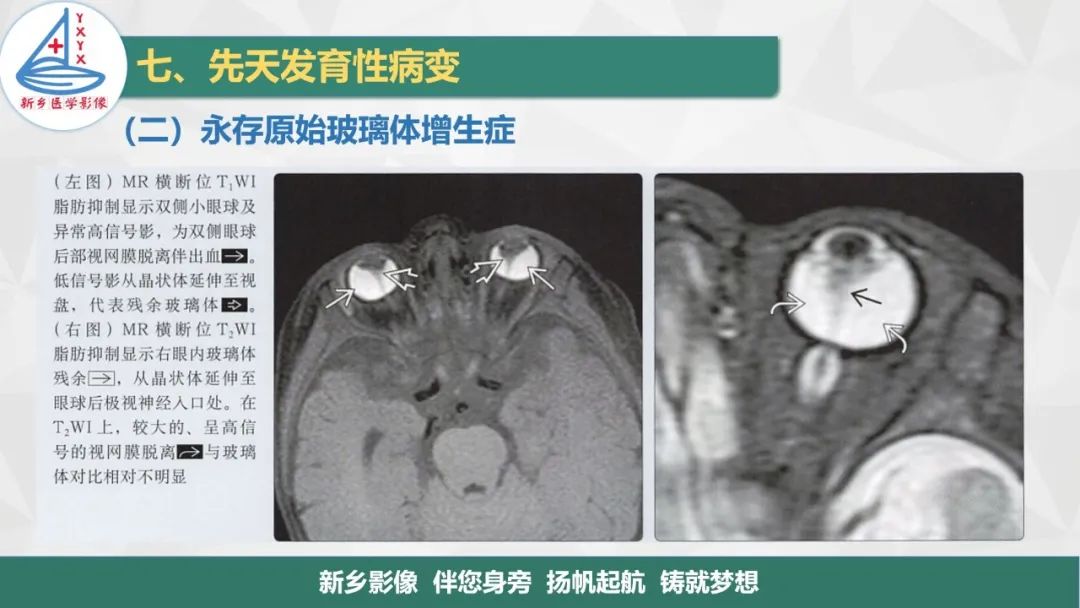 影像PPT - 【PPT】医学影像诊断学教材解读—眼部疾病-28