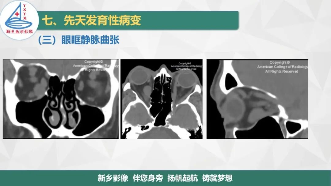 影像PPT - 【PPT】医学影像诊断学教材解读—眼部疾病-30