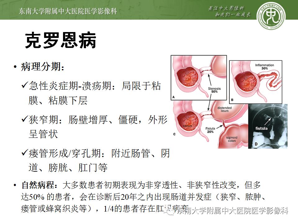 影像PPT - 【PPT】克罗恩病及常见并发症-9