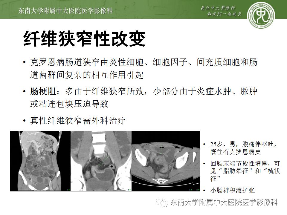 影像PPT - 【PPT】克罗恩病及常见并发症-15