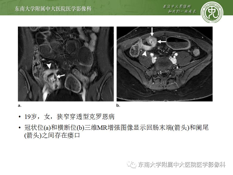 影像PPT - 【PPT】克罗恩病及常见并发症-17